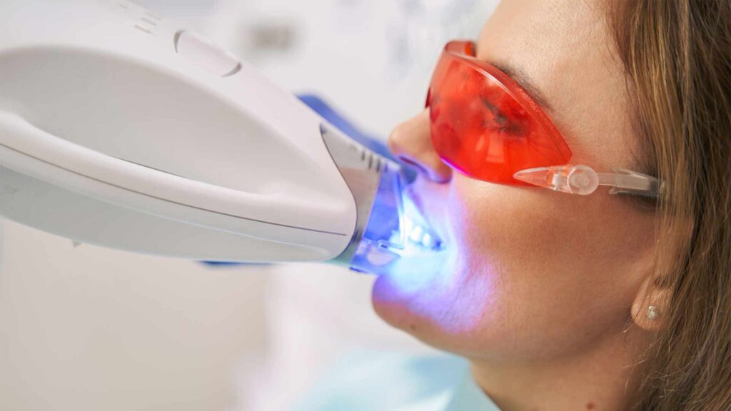 Kezelesek fogfeherites 01 3t dental pecs