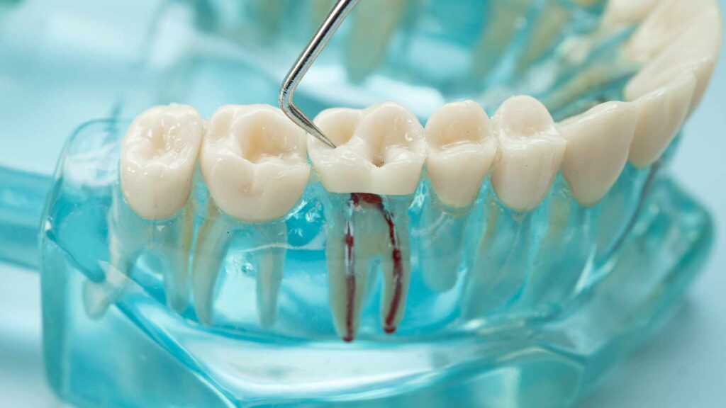 Kezelesek gyokerkezeles 01 3t dental pecs