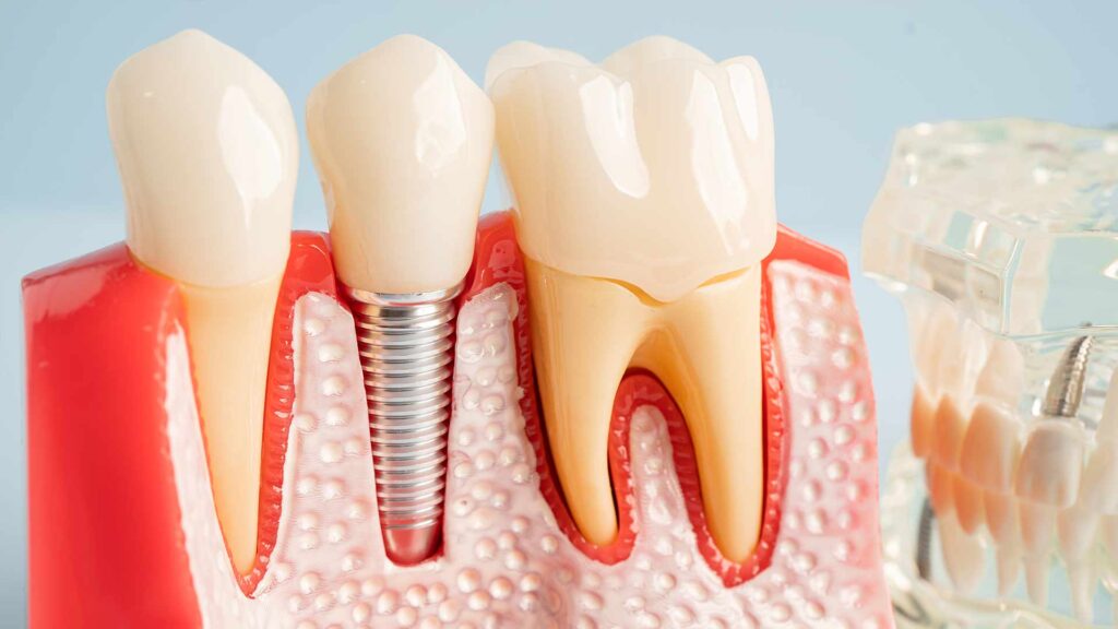 Kezelesek implant 01 3t dental pecs